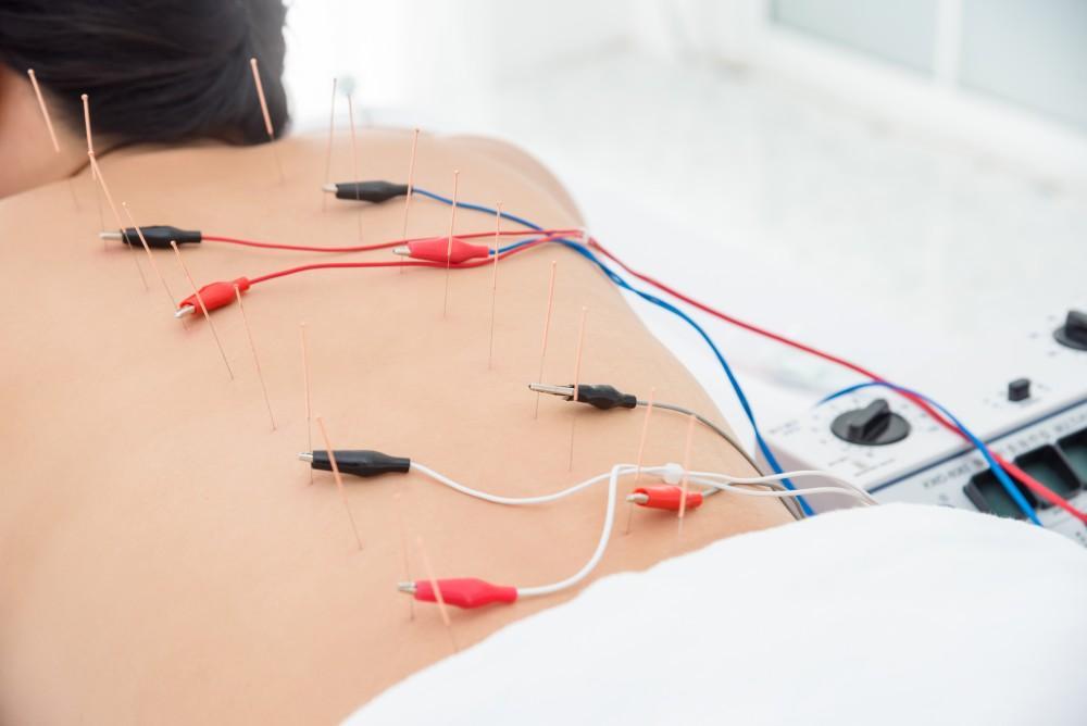 Acupuncture with stimulation