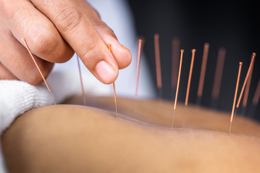 Acupuncture without stimulation